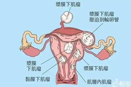 子宫肌瘤的分型