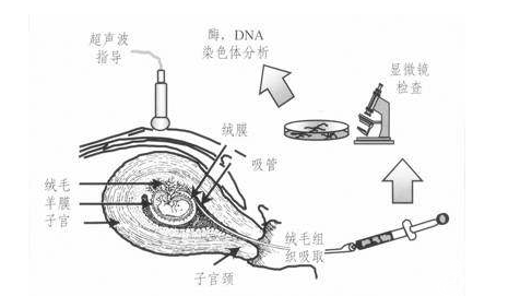 绒毛穿刺是什么检查