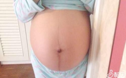 妊娠纹刚开始长的图片