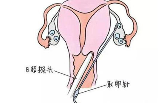 卵巢穿刺