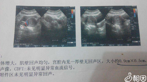怀双胞胎两个月肚子图