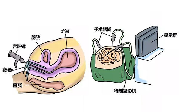宫腔镜检查步骤图片