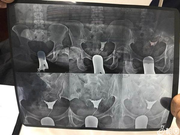 双侧输卵管堵塞还能治疗吗