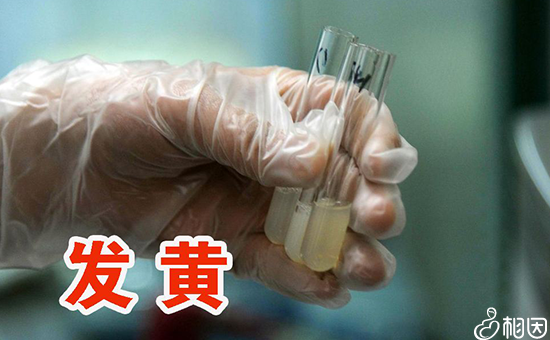死精症检查项目有哪些