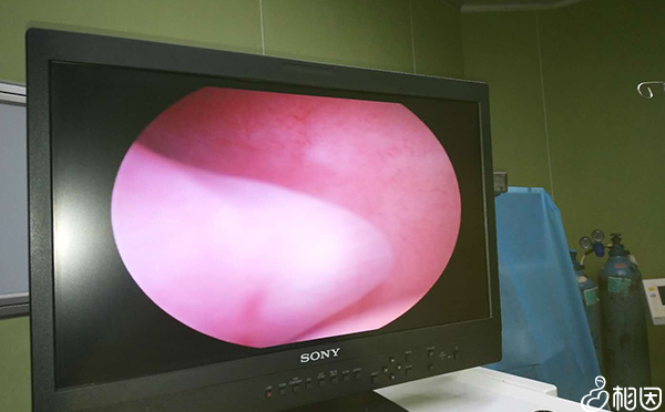 什么叫宫腔镜检查