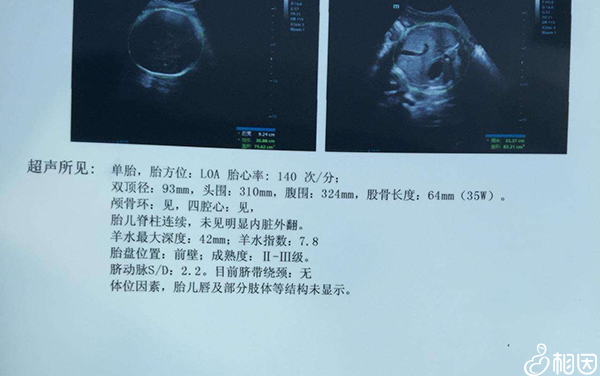 B超检查胎心率