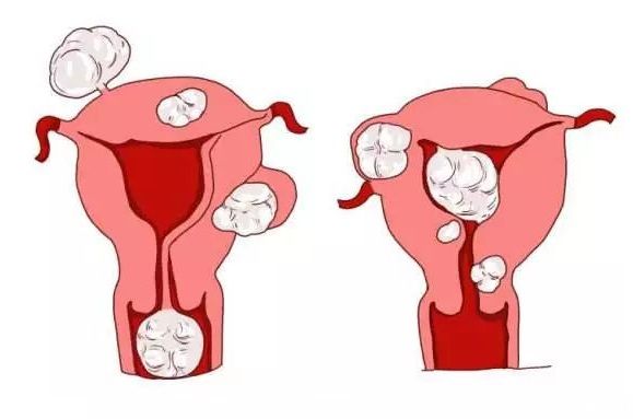 多数子宫肌瘤不影响试管婴儿