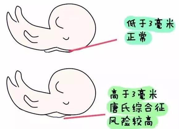 NT检查