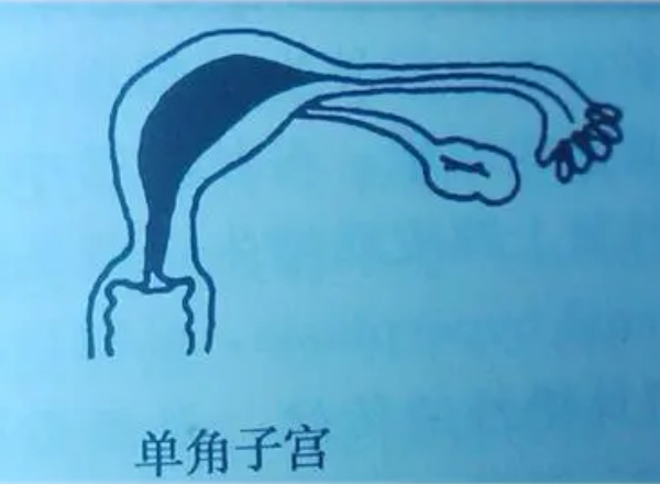 单角子宫怀孕得做好检查