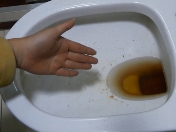晨尿发黄不能看男女