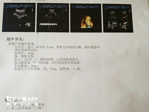 脐带绕颈应该做彩超检查
