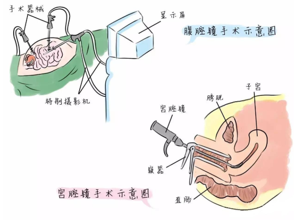 宫腔镜检查的示意图