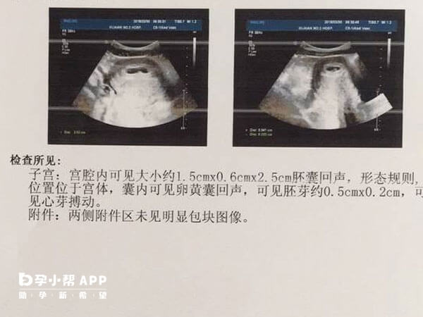 胚芽大小会随着孕周增加而增加