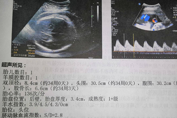 试管婴儿一超确定胎儿是否宫内妊娠