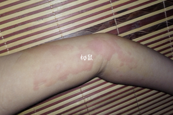 孕期过敏性荨麻疹不能乱用药