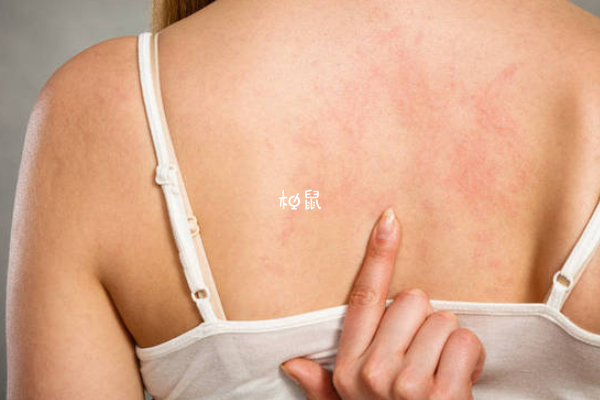 孕期预防荨麻疹要注意天气变化