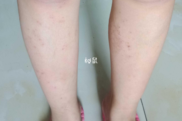 孕期胆汁淤积会有一些症状