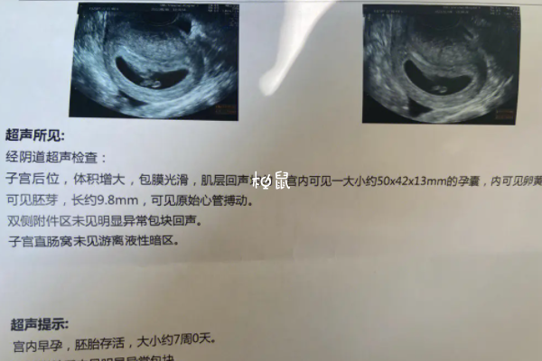 血友病会影响个人健康