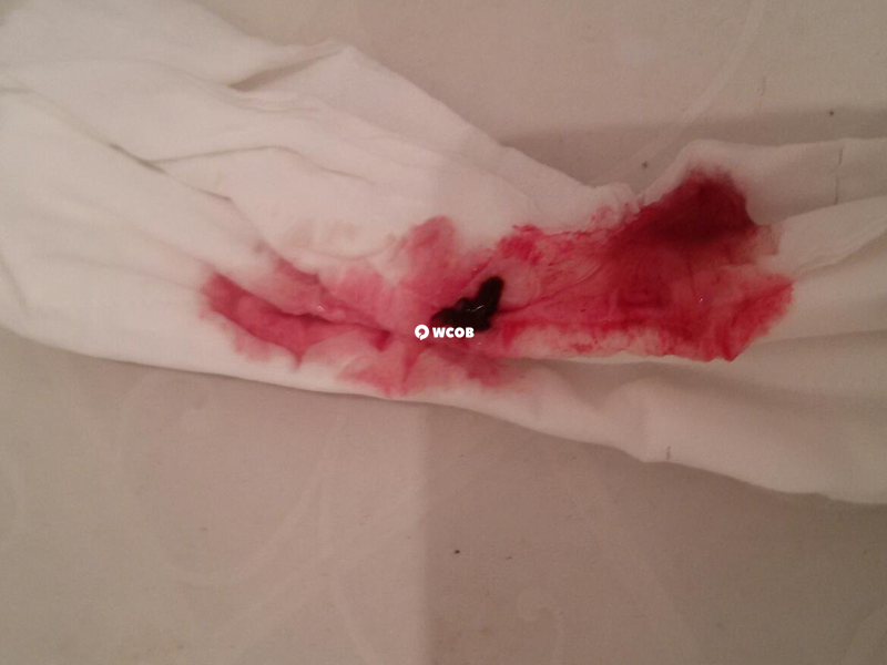 孕24周见红保胎成功率还不错