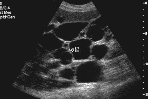 多囊肾会严重影响个人健康
