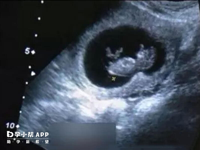 nt值略高不影响要孩子