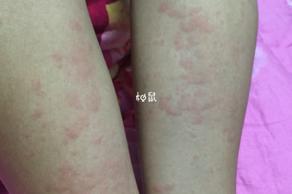 孕期胆汁淤积容易瘙痒