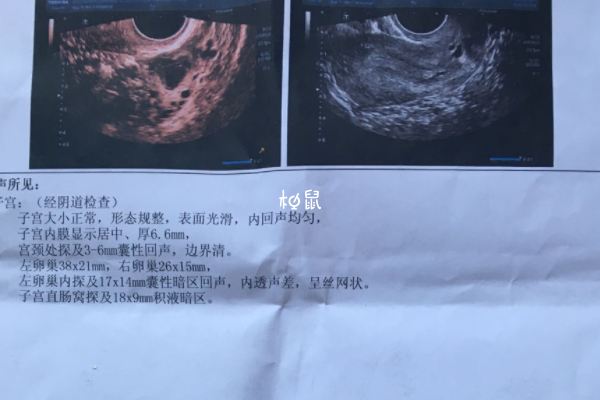 子宫彩超有的需要憋尿