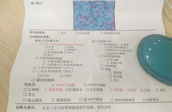 tct检查的主要目的是为了检查宫颈癌