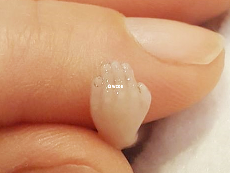孕期甲状腺功能控制不好会导致流产