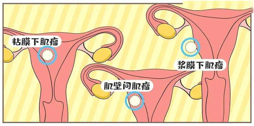 常见子宫类疾病