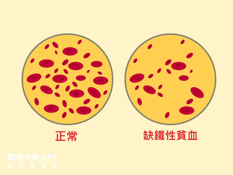 地中海贫血的类型