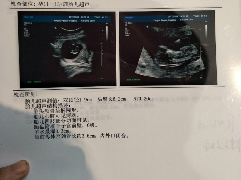 正常nt值不得超过2.5mm